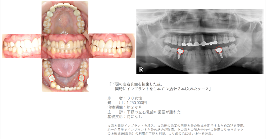 下顎の左右乳歯を抜歯した後、 同時にインプラントを１本ずつ(合計２本)入れたケース -インプラント治療の症例集 インプラント治療ならナチュラル インプラント